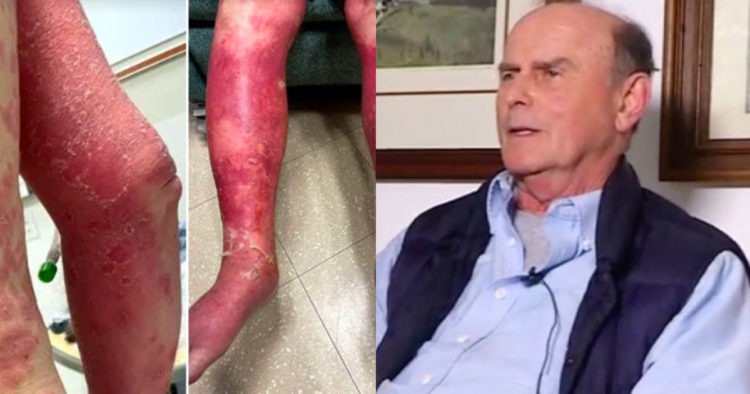 HORRIFYING: Mans Skin Peeled Off Due To Reaction From Johnson & Johnson COVID Vaccine