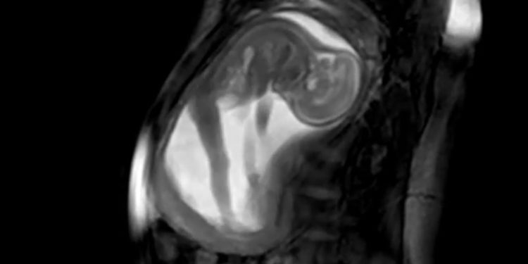 Amazing Footage of Baby at 20 Weeks Gestation Shows Budding Personality, Detailed Features